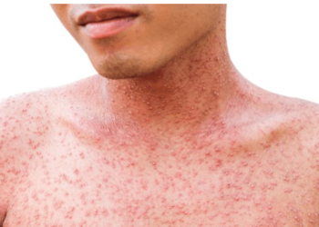 Disminuyen casos ambulatorios de viruela del mono en Quintana Roo