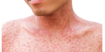 Disminuyen casos ambulatorios de viruela del mono en Quintana Roo