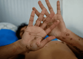 Quintana Roo confirma dos casos más de viruela de mono