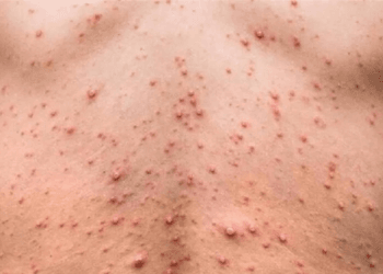 Quintana Roo refuerza medidas contra el mpox