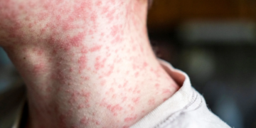 México registra primera muerte por sarampión en medio de brote nacional